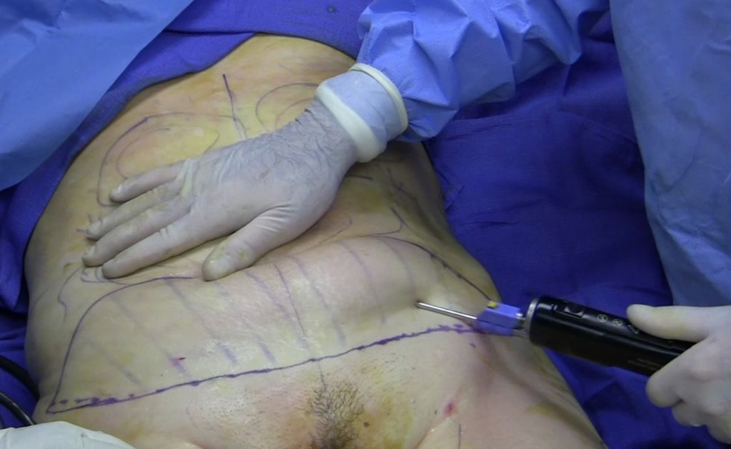 lipo8